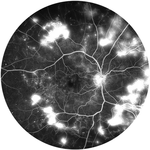 Diabetic Retinopathy
