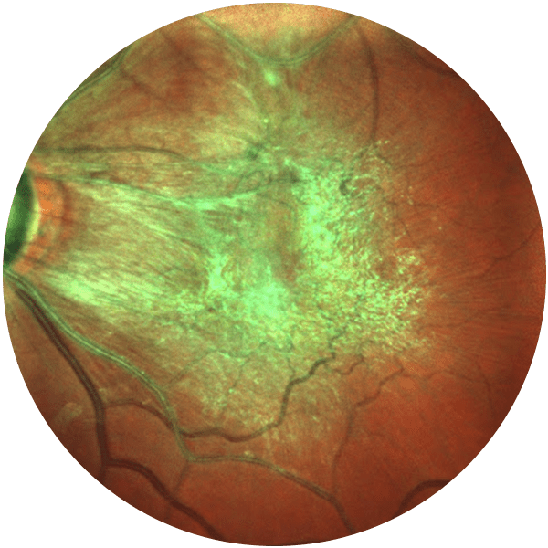 Epiretinal Membrane