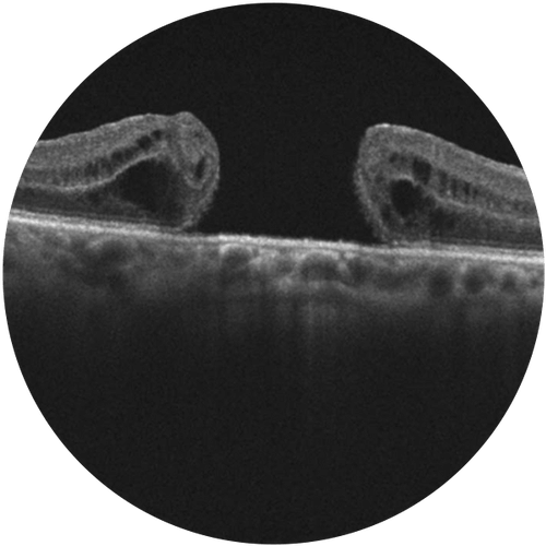 Macular Hole