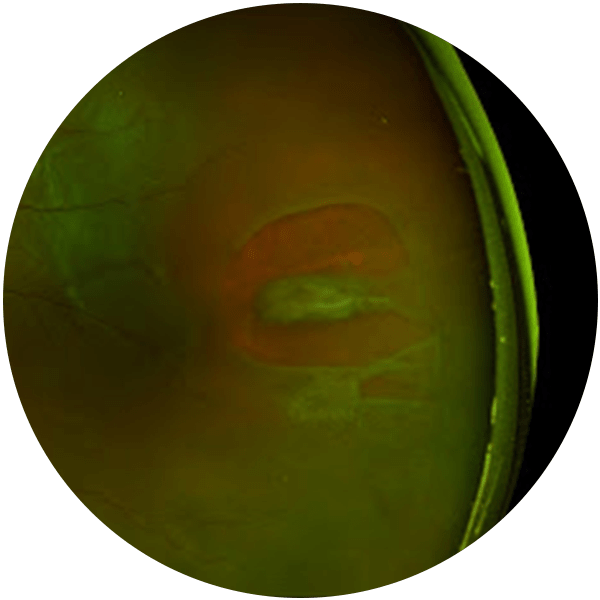 Retinal Tears